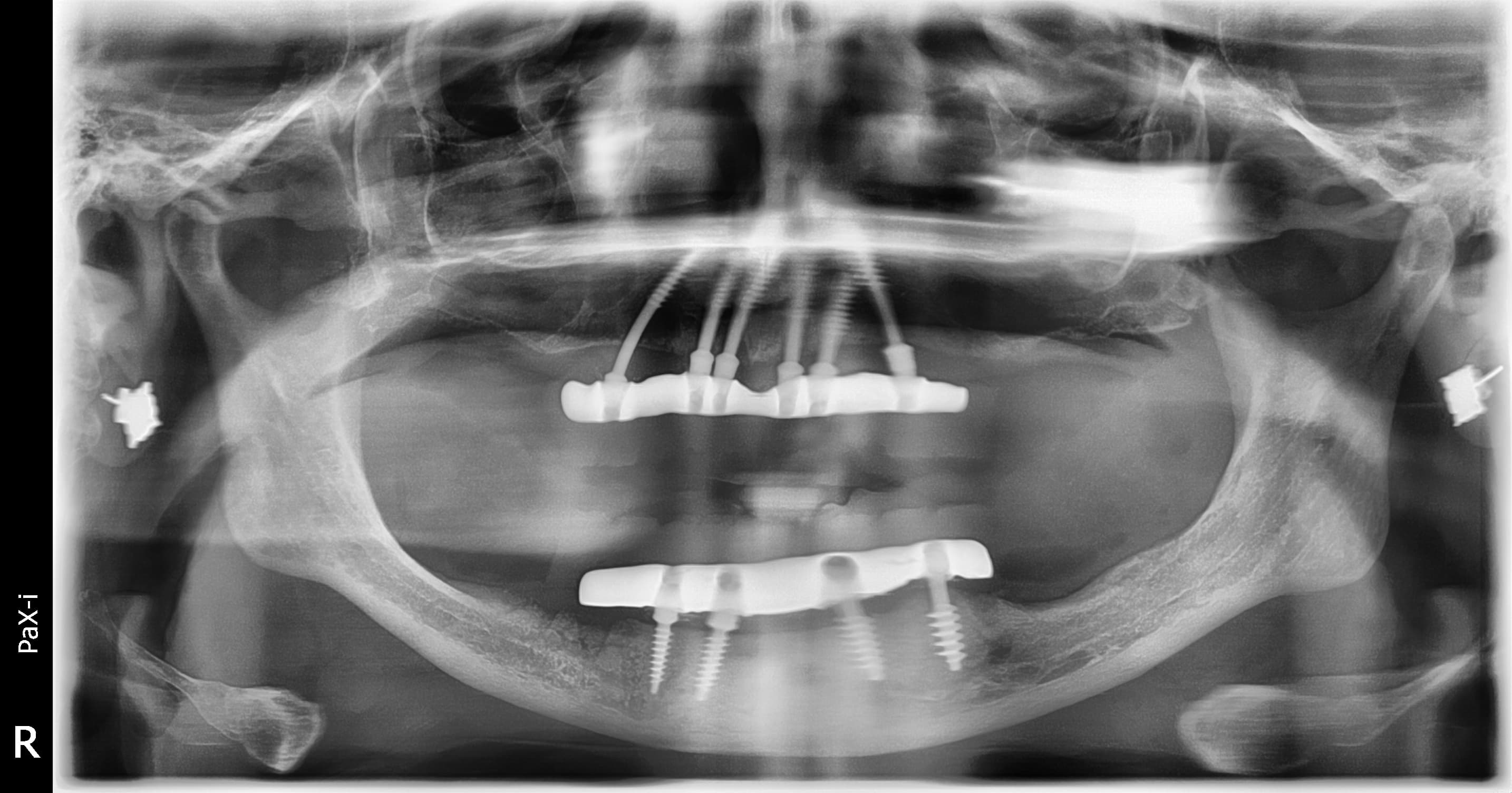 After treatment: fixed full-arch implant-supported bridges in both jaws