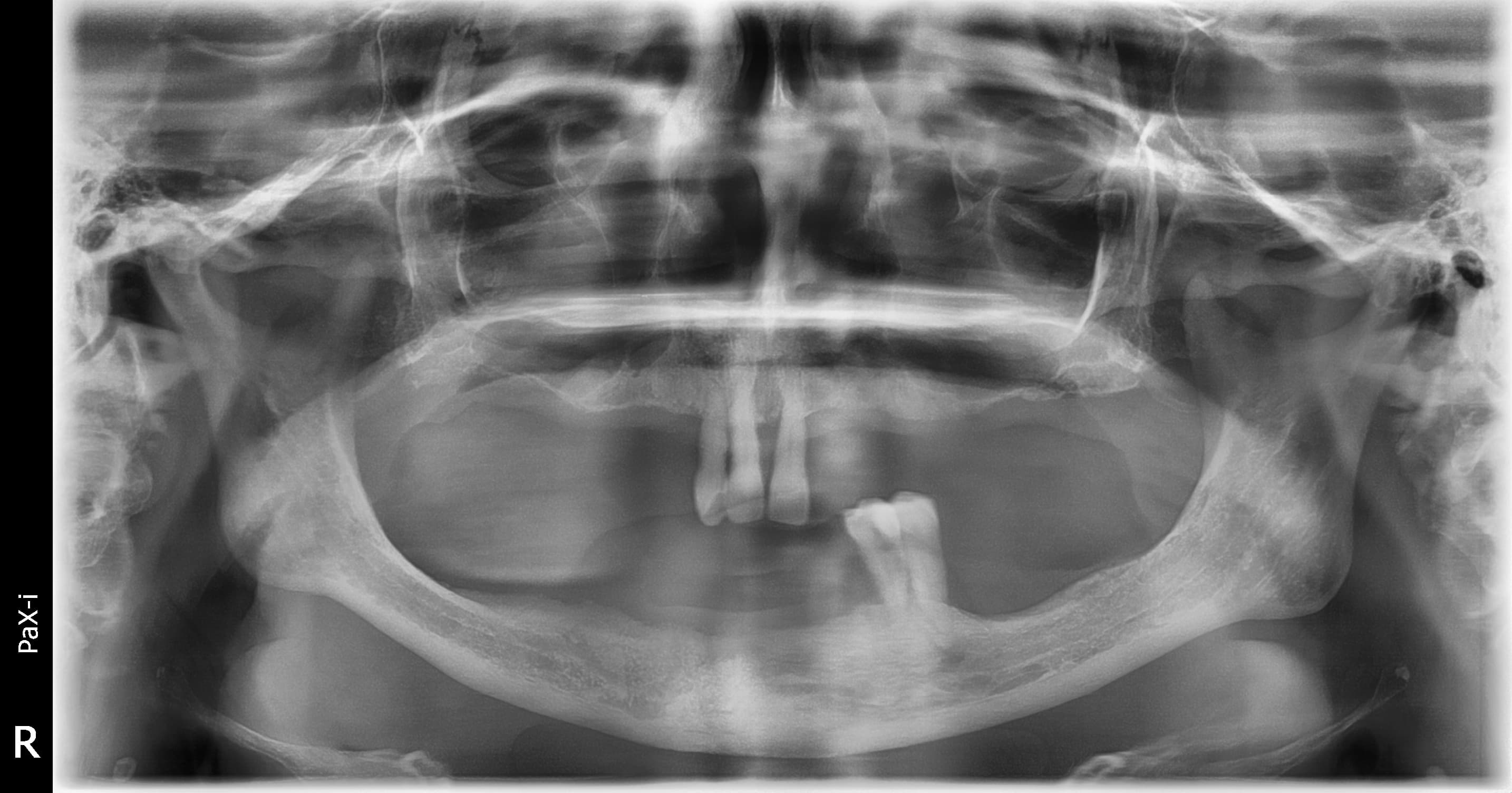 Before treatment: compromised residual dentition with removable partial dentures