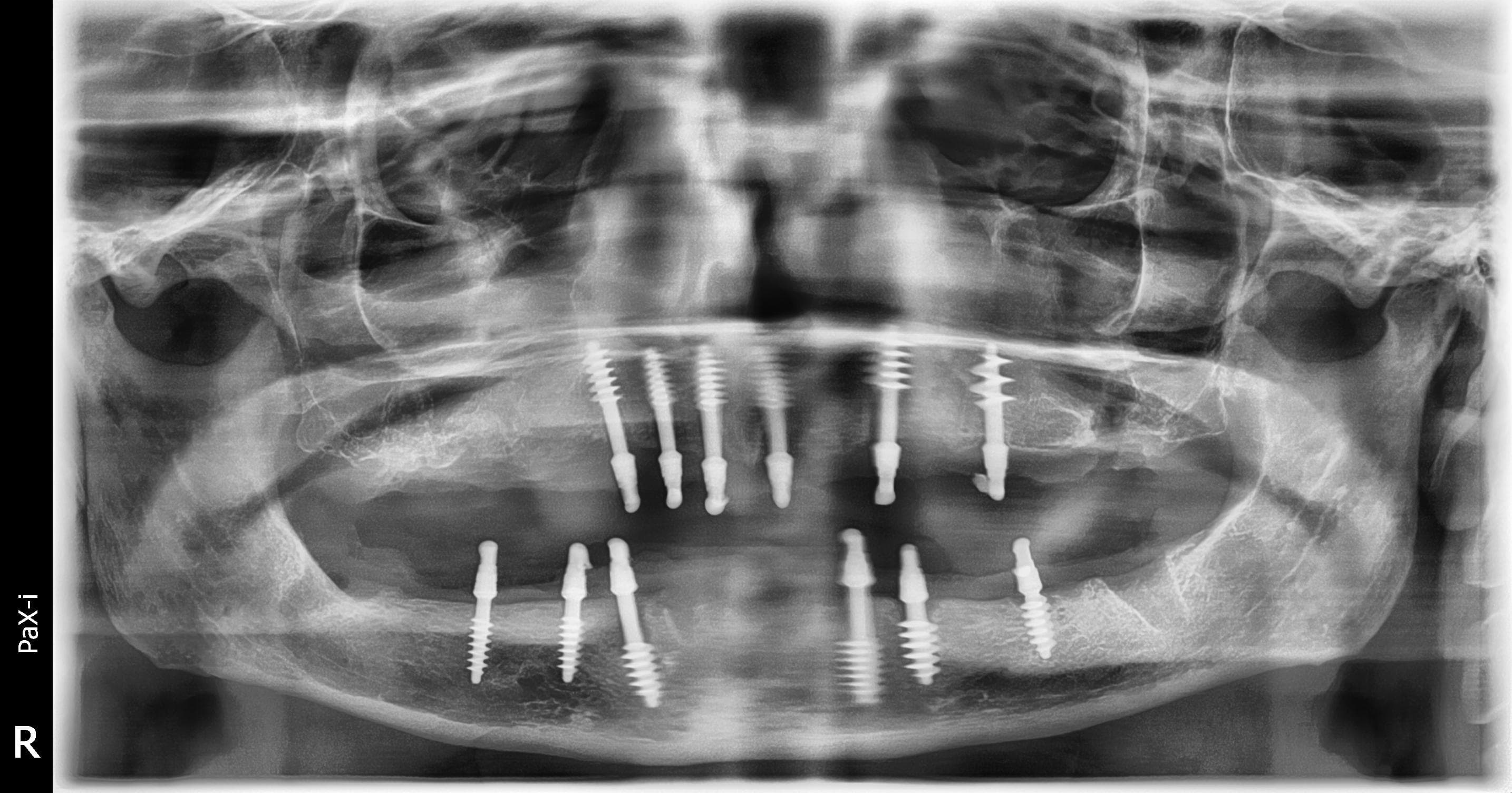 After treatment: fixed full-arch implant-supported rehabilitation of both jaws