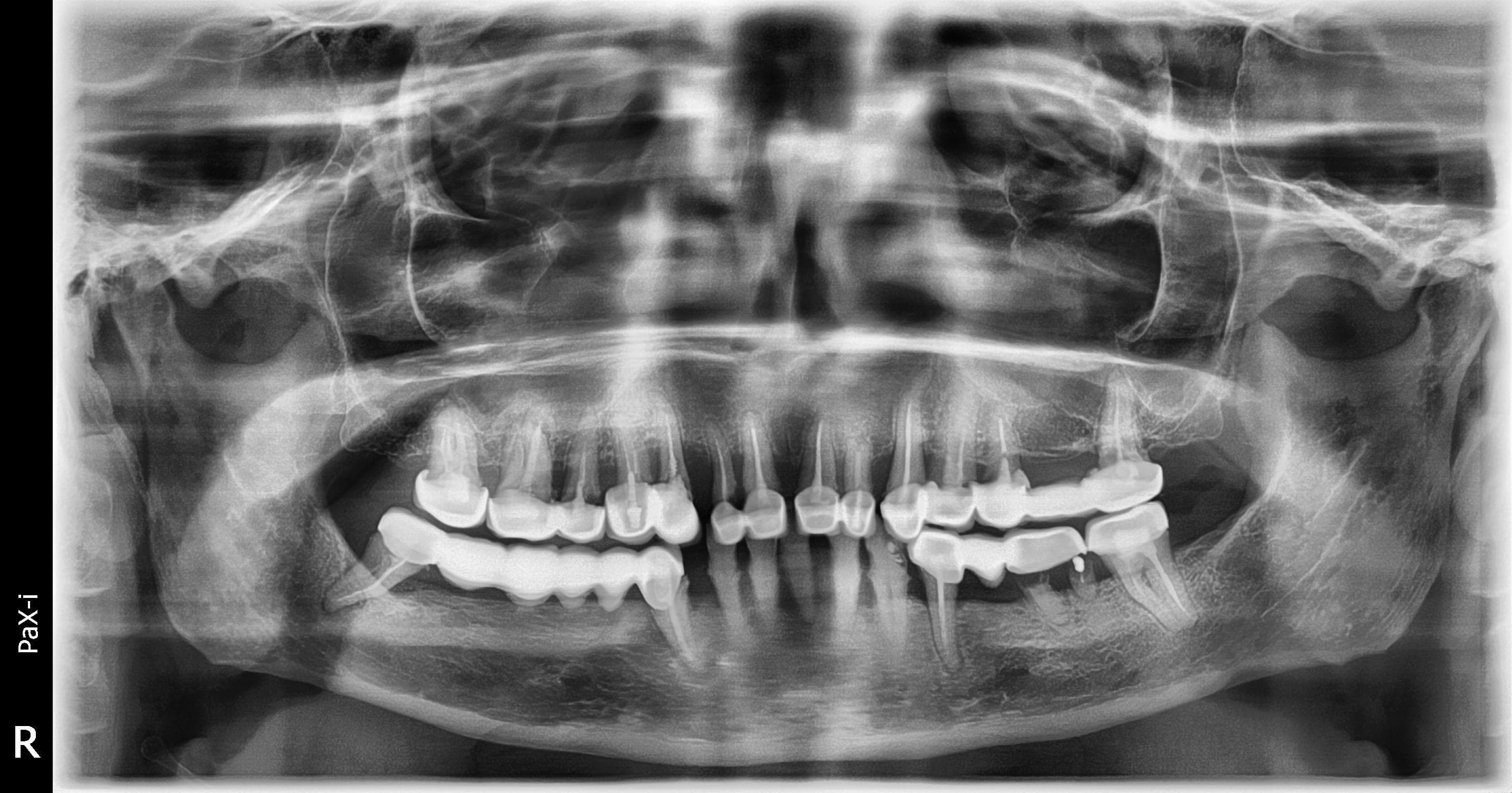 Before treatment: remaining dentition with metal-ceramic restorations and periodontitis