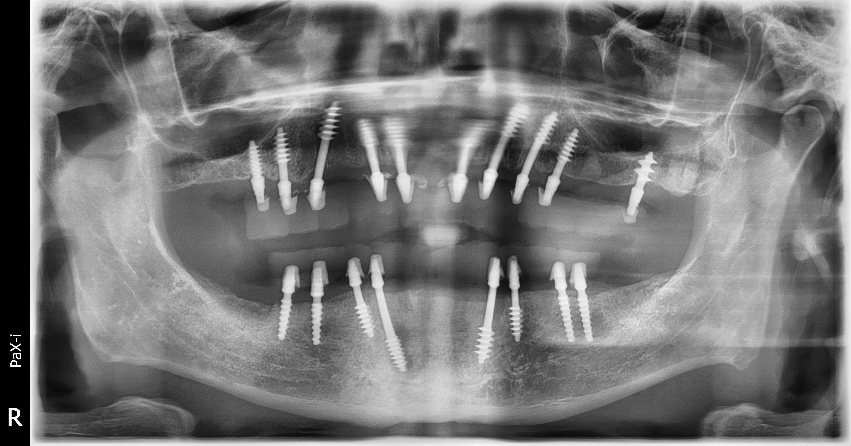 After treatment: fixed full-arch implant-supported restorations of both jaws
