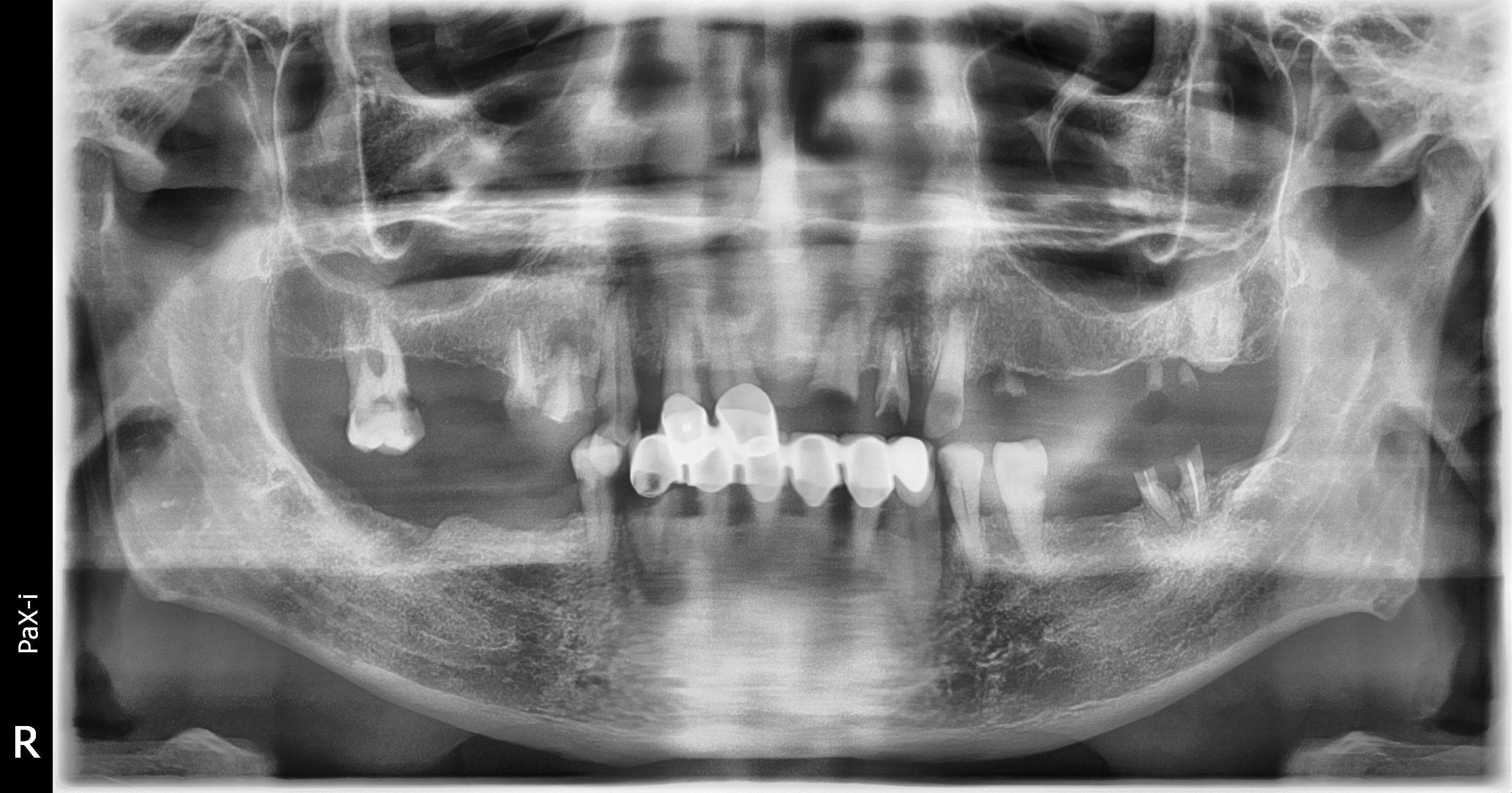 Before treatment: compromised and fractured dentition with periodontitis