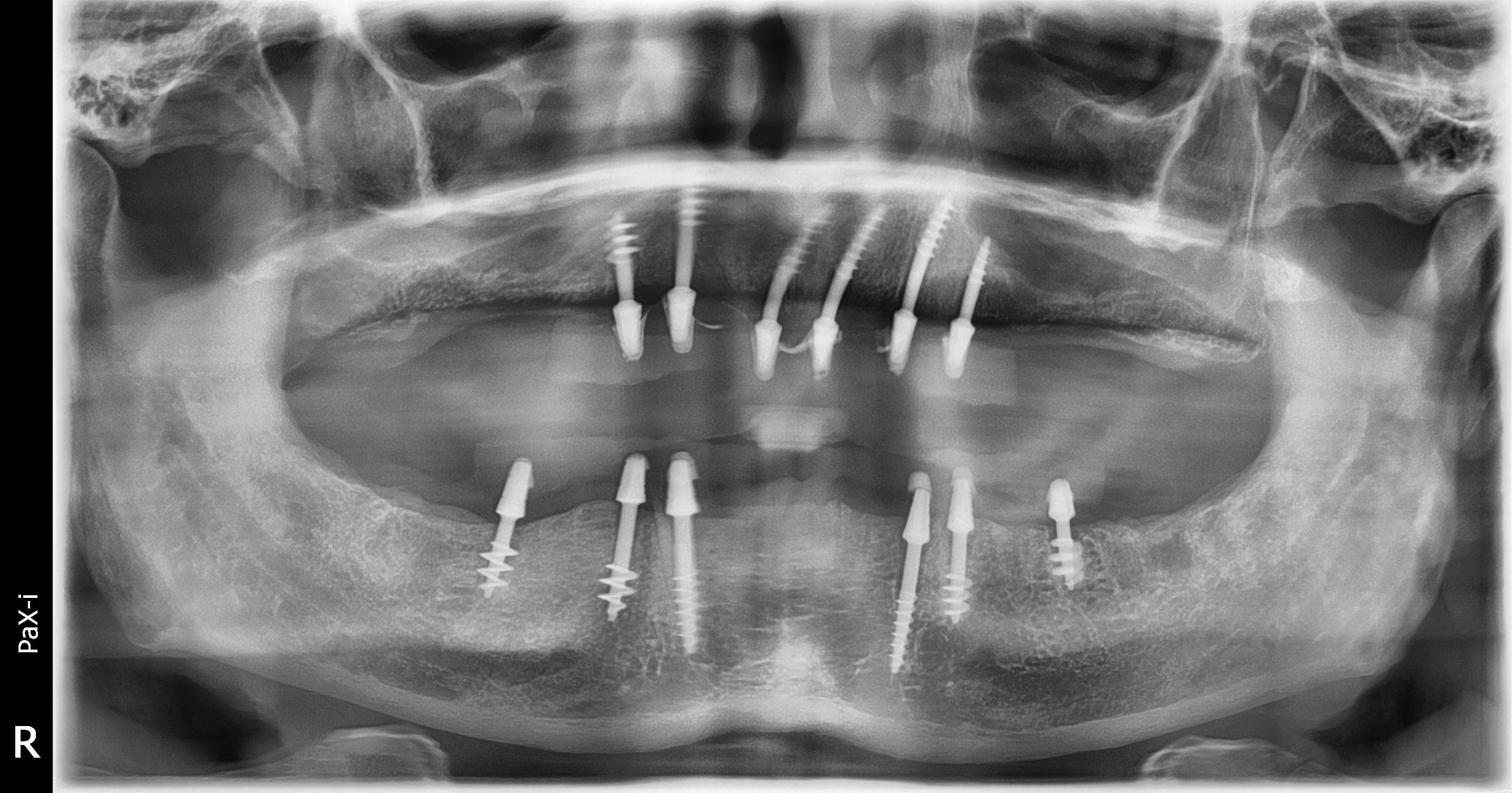 After treatment: fixed full-arch implant-supported restorations of both jaws