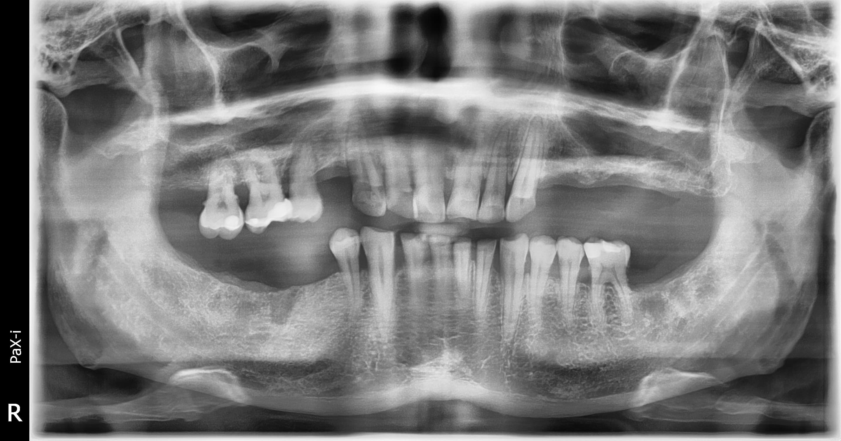 Before treatment: periodontitis with partial edentulism in both jaws