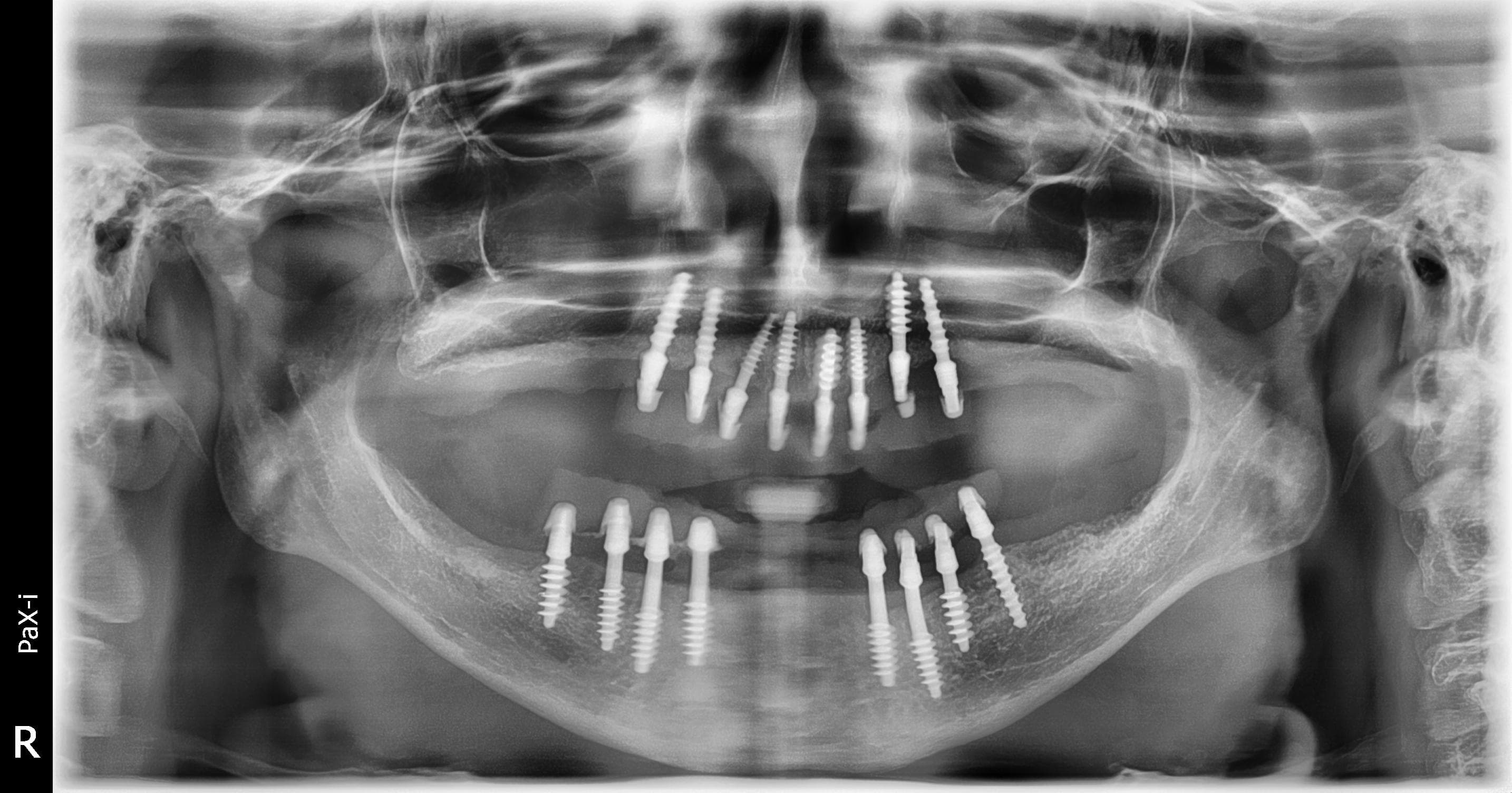 After treatment: fixed full-arch implant-supported restorations of both jaws