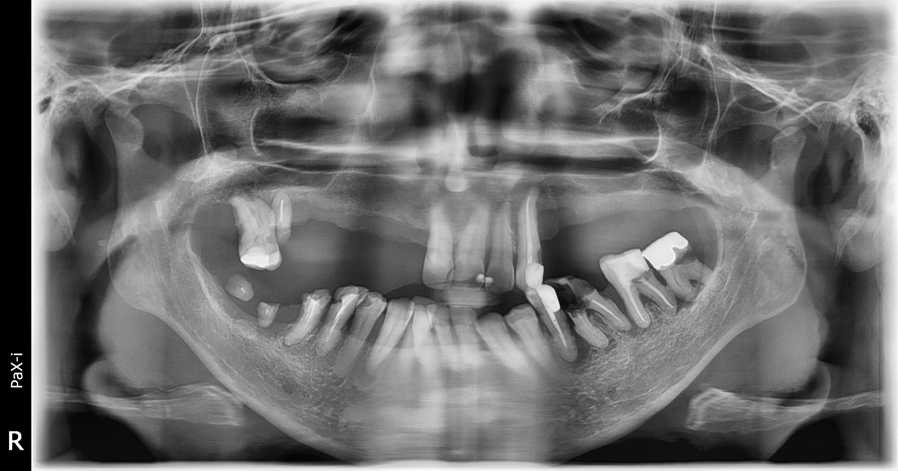 Before treatment: periodontitis with root remnants and partial edentulism