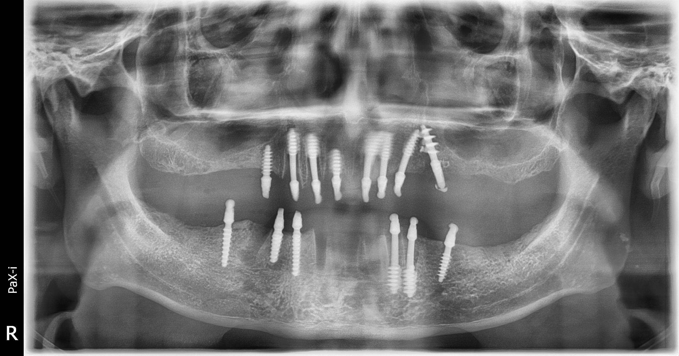 Post-operative panoramic radiograph after bicortical implant placement