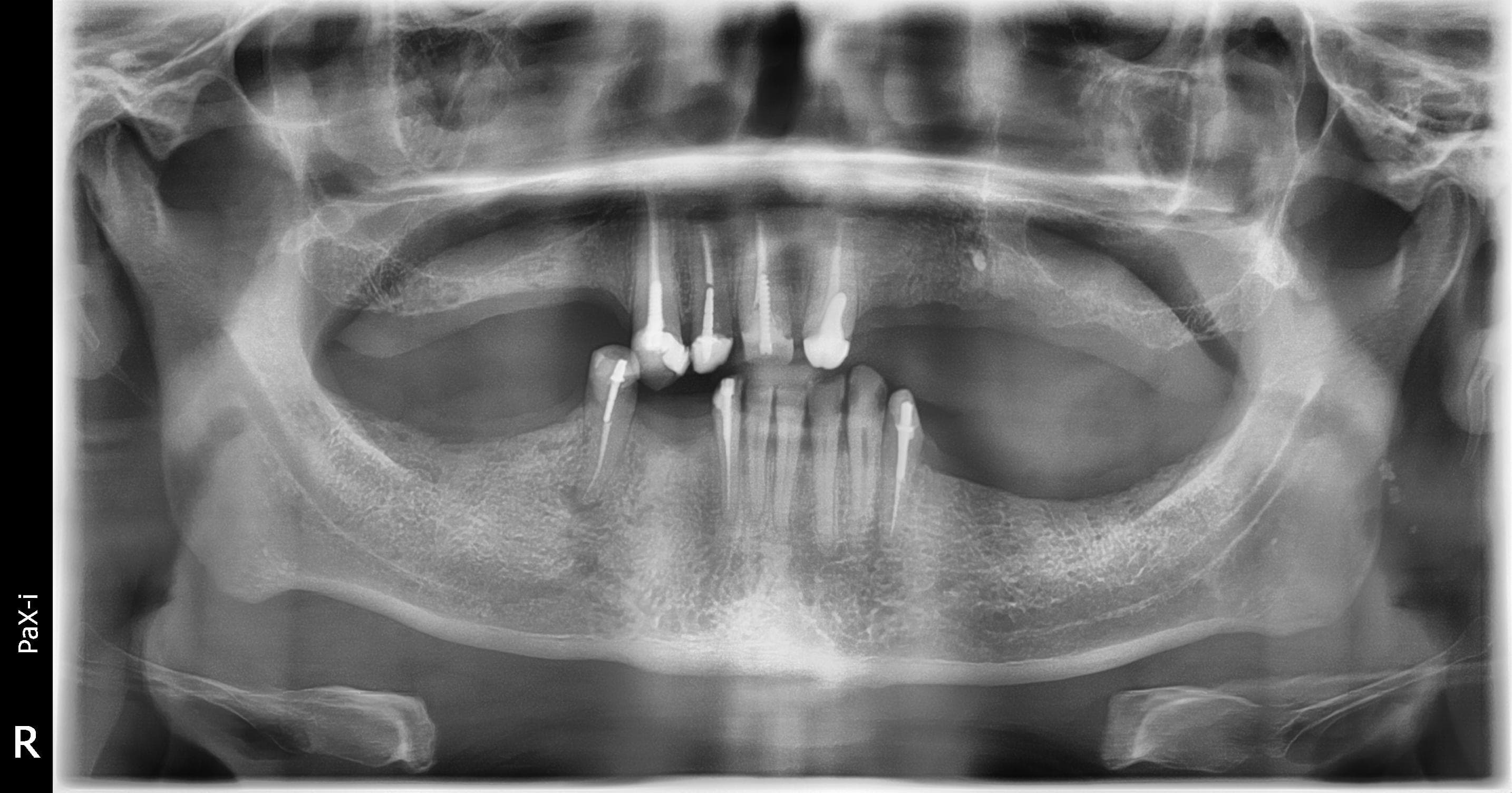 Pre-operative panoramic radiograph showing extensive partial edentulism