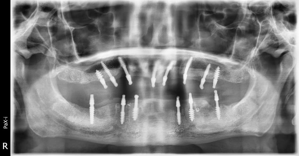 Post-operative panoramic radiograph after bicortical implant placement