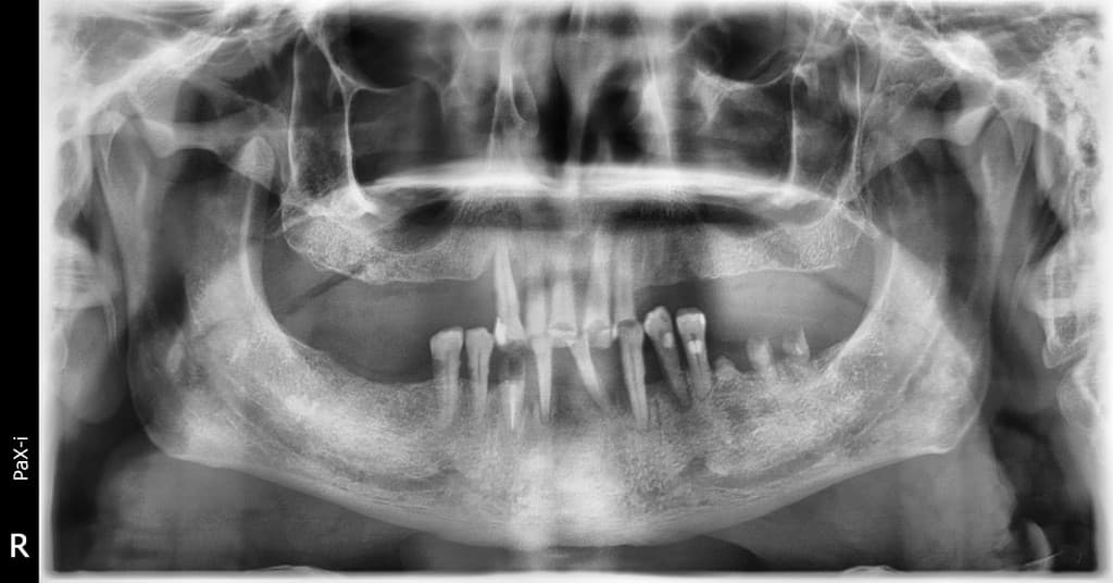 Pre-operative panoramic radiograph with compromised dentition and root remnants