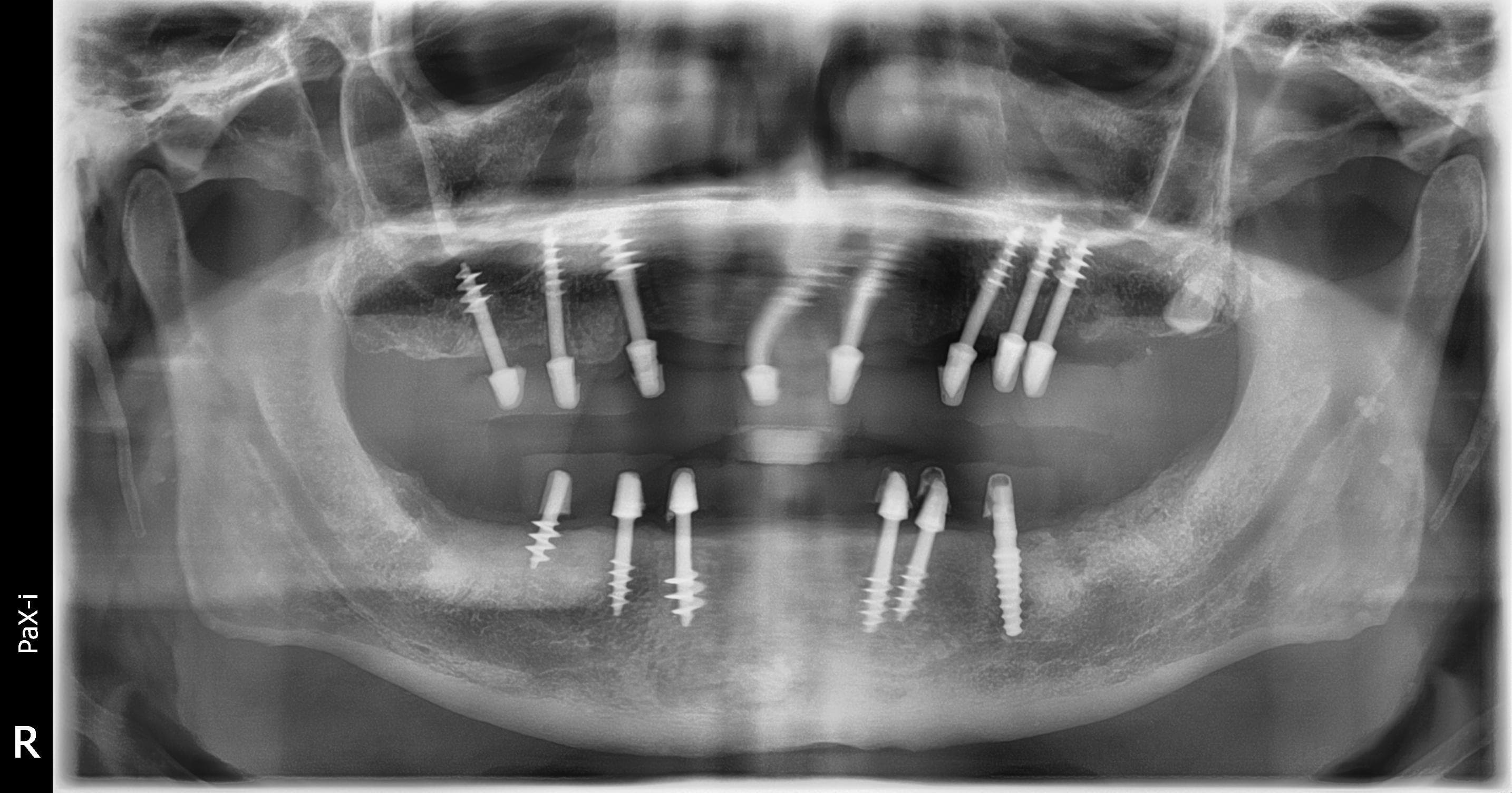 Post-operative panoramic radiograph after bicortical implant placement