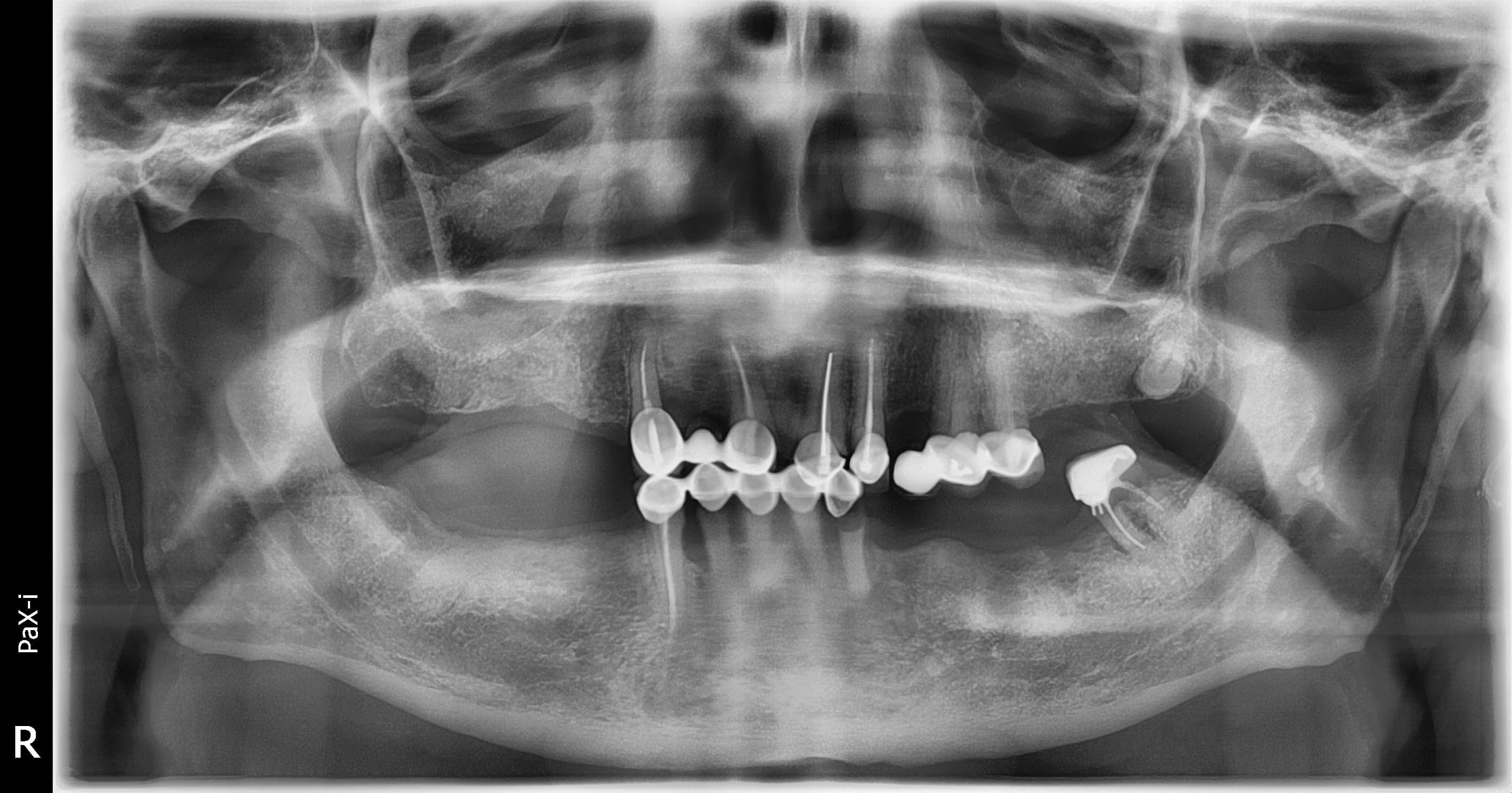 Pre-operative panoramic radiograph with failing bridges and partial edentulism