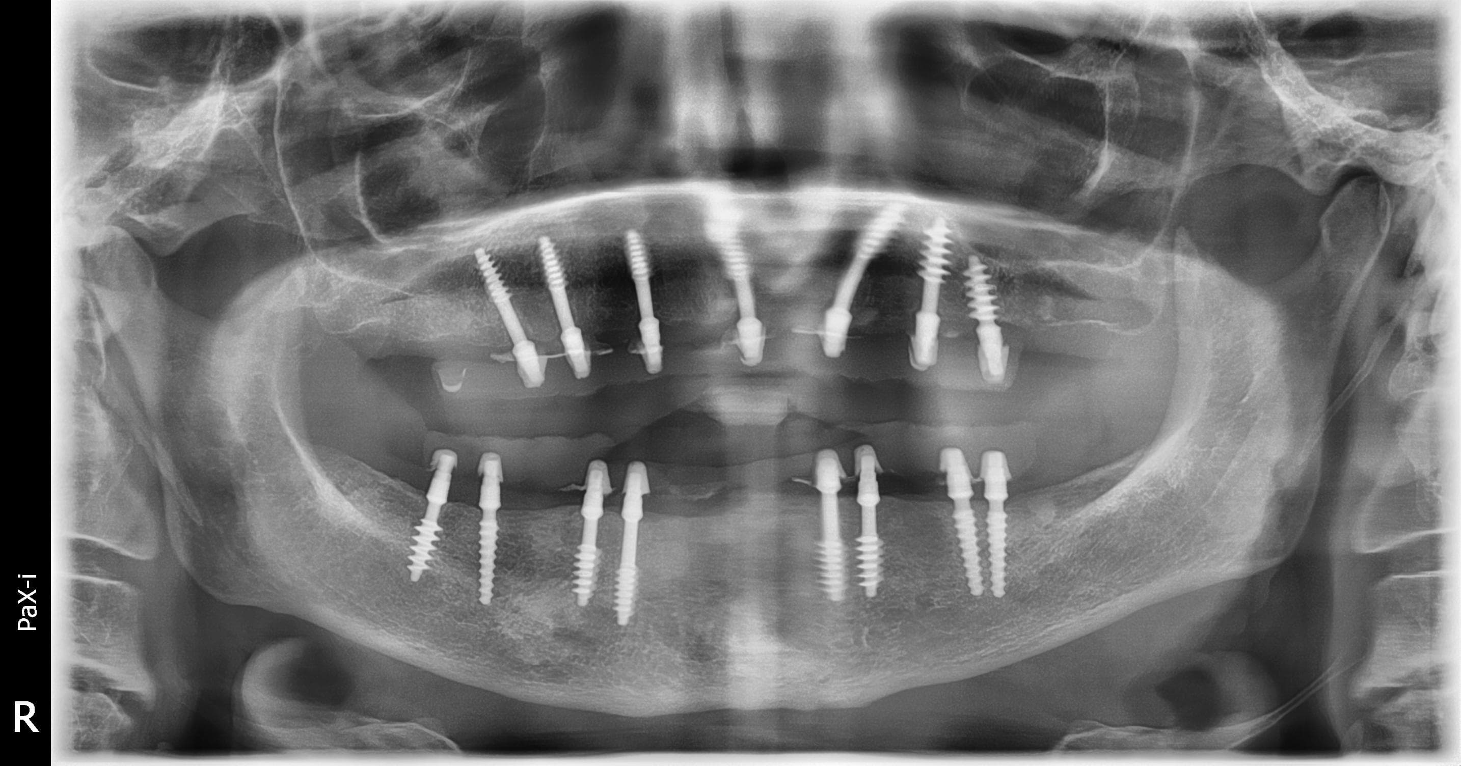 Post-operative panoramic radiograph after bicortical implant placement
