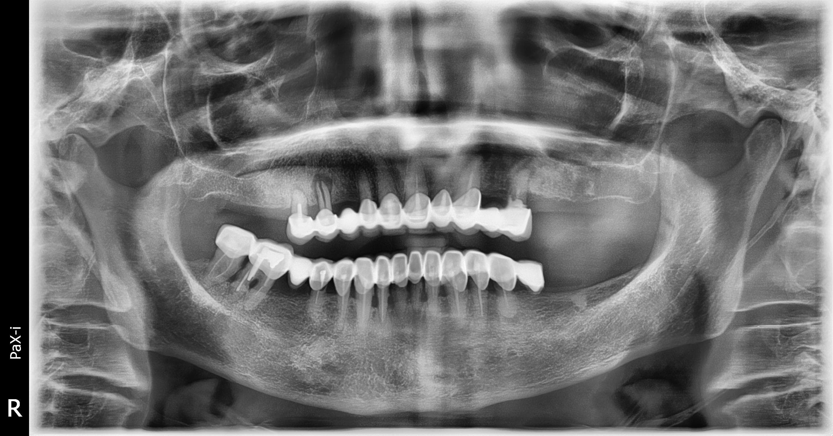 Pre-operative panoramic radiograph with failing metal-ceramic bridges