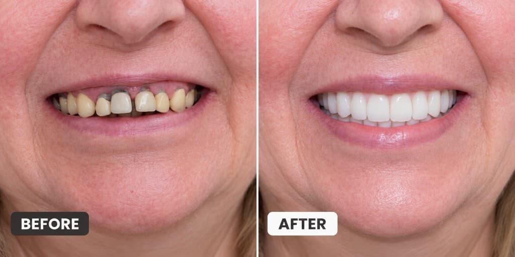 Before and after: missing and failing upper teeth restored with a full fixed smile