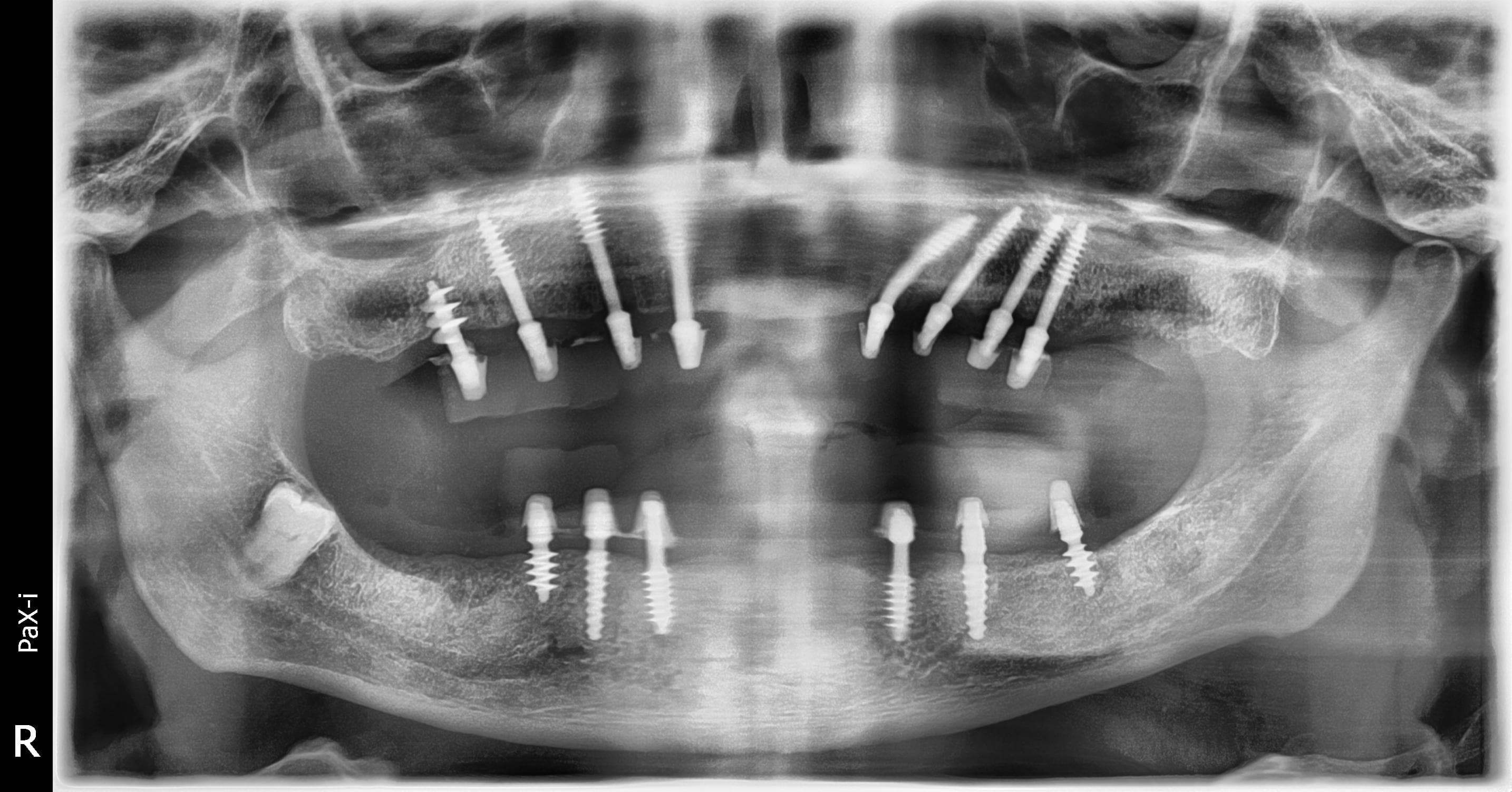 Post-operative panoramic radiograph after implant placement with retained impacted 48