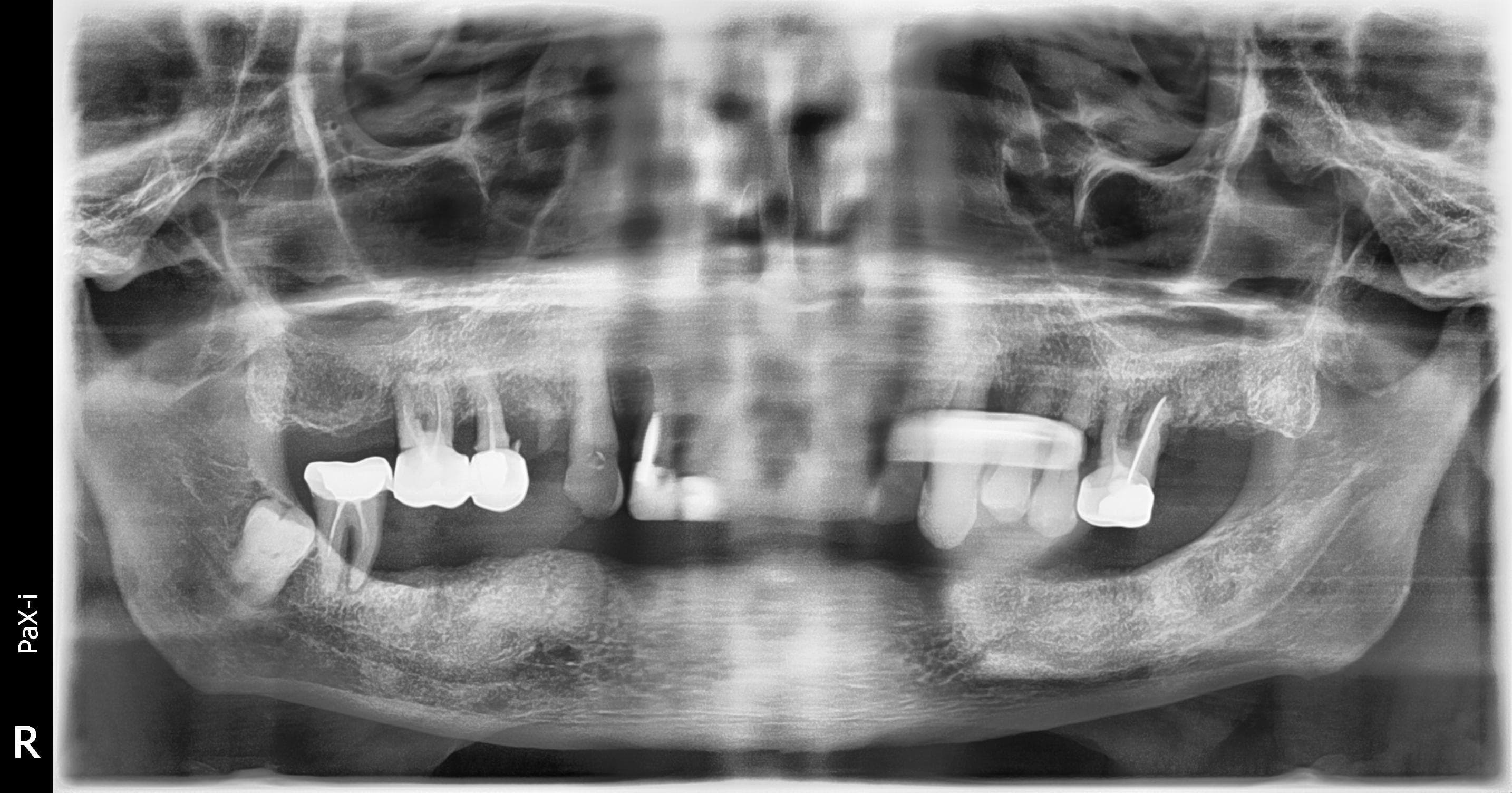 Pre-operative panoramic radiograph with extensive mandibular edentulism