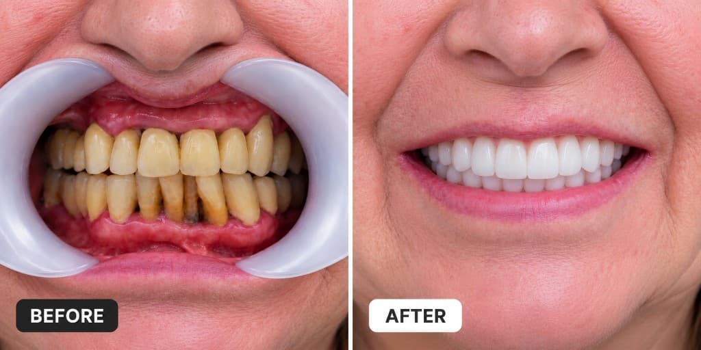 Before and after: worn stained teeth restored with a bright aligned smile