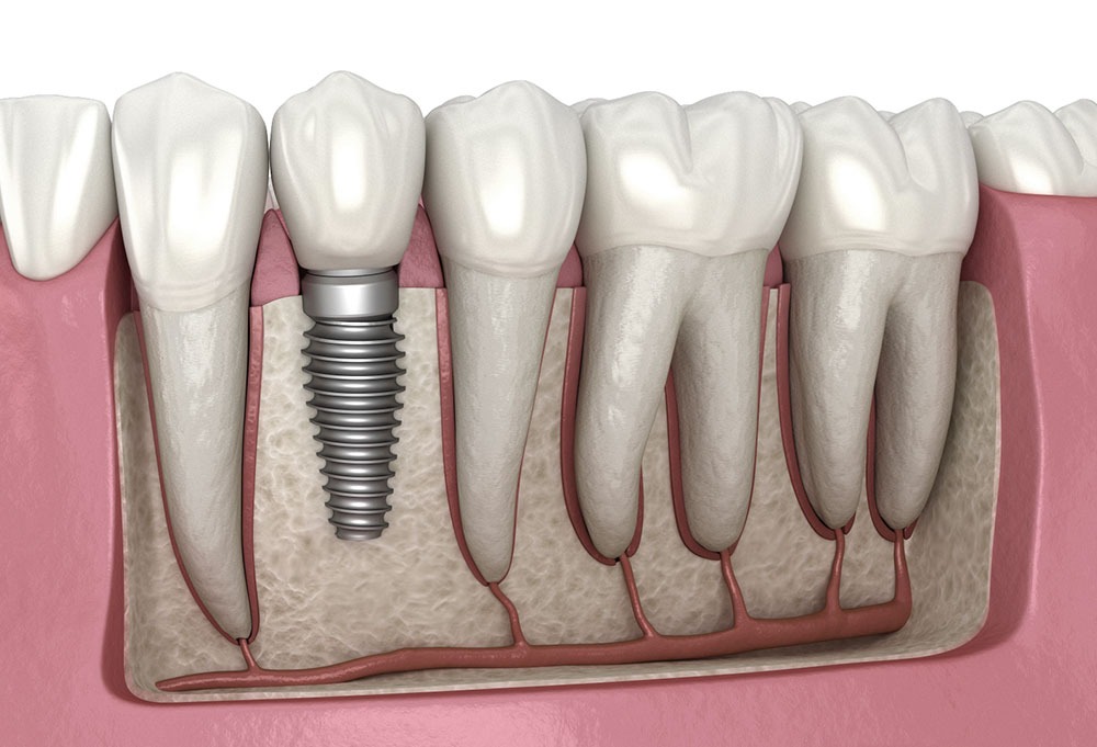 3D illustration of a conventional dental implant in the lower jaw next to natural teeth