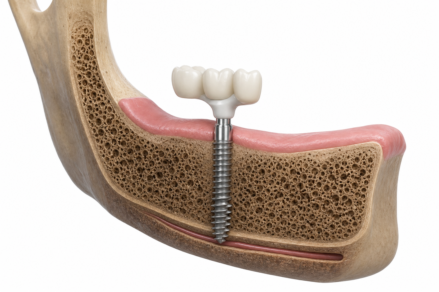 Realistic 3D cross-section of a screw-type basal implant engaging dense cortical bone under a reduced ridge